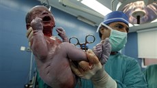 Chlapeček přivedený na svět císařským řezem. Snímek pochází z porodnice v... Chlapeček přivedený na svět císařským řezem. Snímek pochází z porodnice v...