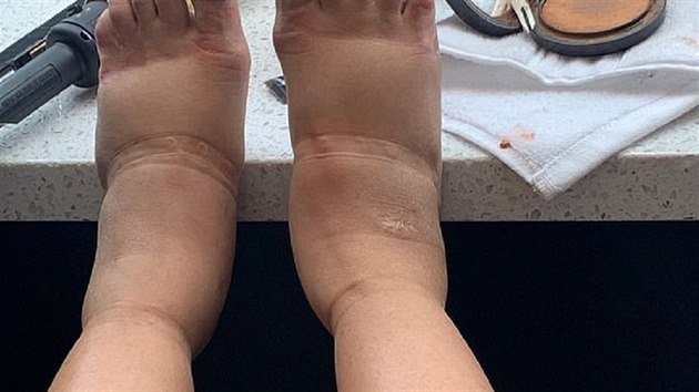 Cardi B sdlela na Instagramu v thotenstv fotku svch oteklch nohou. (2019)