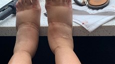 Cardi B sdílela na Instagramu v thotenství fotku svých oteklých nohou. (2019)