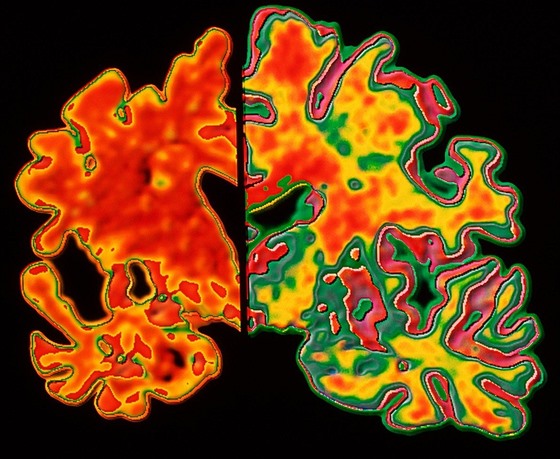 Snímek ve falených barvách ukazuje strukturální rozdíly mezi zdravým mozkem a...