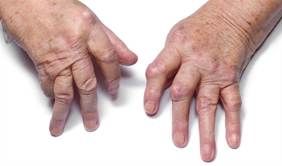 Ruce pokozené revmatoidní artritidou