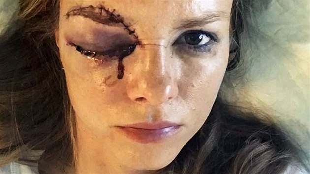 Hrozivá stopa po puku, který slovenské televizní reportérce Barboře Žiačikové... Hrozivá stopa po puku, který slovenské televizní reportérce Barboře Žiačikové...