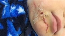 Špatně upevněná lyžařská branka zranila ve skiareálu v Koutech nad Desnou... Špatně upevněná lyžařská branka zranila ve skiareálu v Koutech nad Desnou...