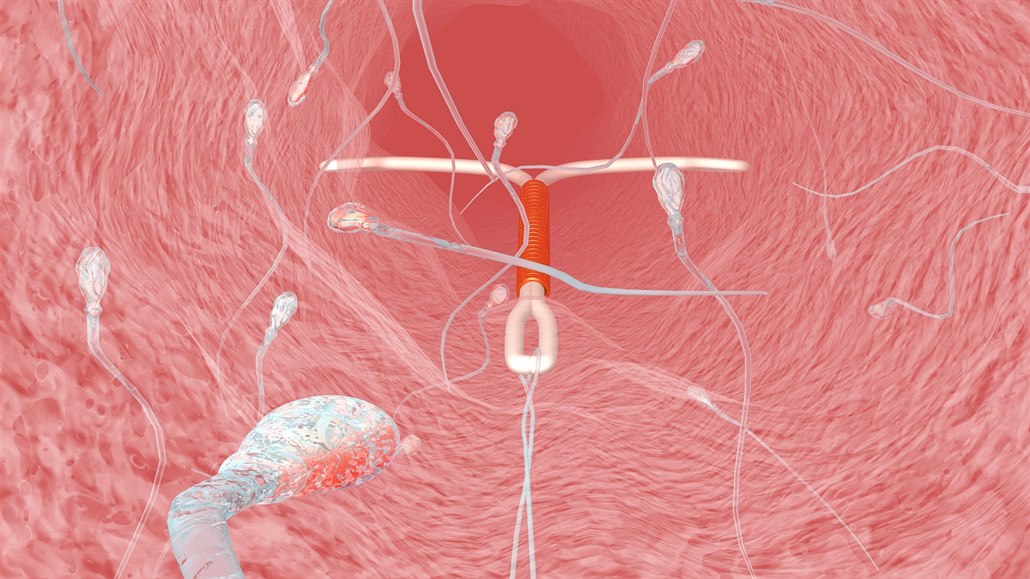 Nitrodloní tlísko obklopené spermiemi