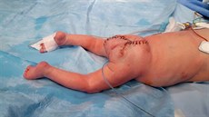 První nitroděložní operaci sakrálního teratomu v Česku provedlo Fetální centrum... První nitroděložní operaci sakrálního teratomu v Česku provedlo Fetální centrum...