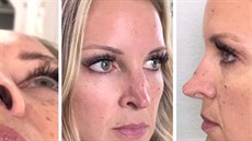 Megan a její nos před finální operací Megan a její nos před finální operací