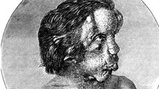 Angličan Joseph Carey Merrick zvaný Sloní muž (5. srpna 1862 – 11. dubna 1890) Angličan Joseph Carey Merrick zvaný Sloní muž (5. srpna 1862 – 11. dubna 1890)