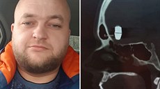 Vladimir Krutov žije deset let s kulkou v hlavě. Vladimir Krutov žije deset let s kulkou v hlavě.