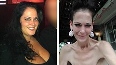 Texasanka Rachel Layou před a po bypassu žaludku. Texasanka Rachel Layou před a po bypassu žaludku.