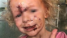 Dívka pokousaná psem na Orlickoústecku Dívka pokousaná psem na Orlickoústecku