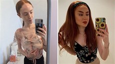 Dívka zvítězila nad anorexií. Dívka zvítězila nad anorexií.