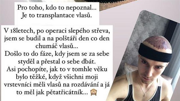 Vtz StarDance Dominik Vodika se na Instagramu svil s tm, e si v minulosti nechal transplantovat vlasy (2021).