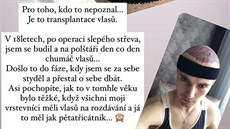 Dominik Vodika ped a po transplantaci vlas