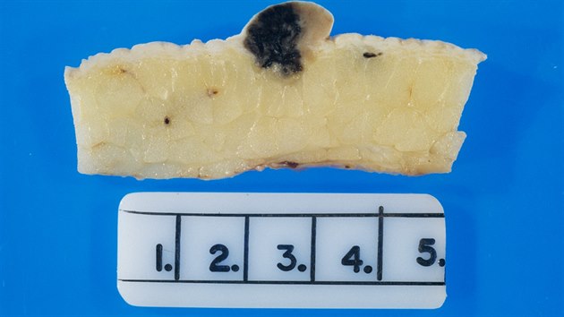 Odstraněný maligní melanom (tmavý útvar). Tento druh nádoru vychází z pigmentotvorných buněk. Hlavní příčinou rakoviny kůže je nadměrné slunění. Jde o agresivní rakovinu, která se často šíří metastázami do jiných částí těla. I proto je důležitá pravidelná kontrola znamének. Včasné odstranění melanomu může pacientovi zachránit život. V Česku je každý rok nově diagnostikováno více než 2 600 případů.