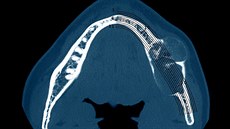 Nádor v dutin ústní, který je v dásni pod zubem na snímku z CT.