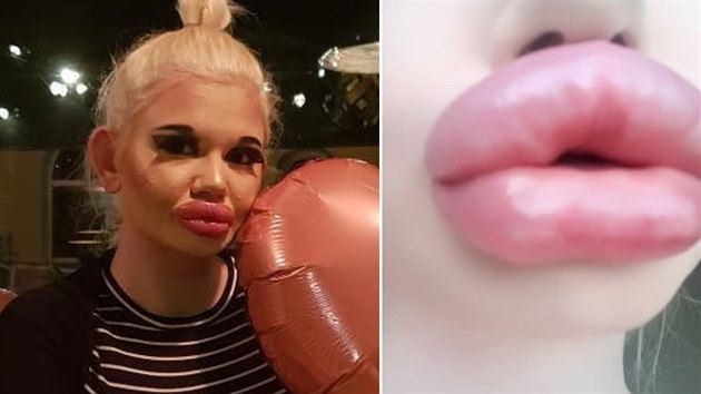 Žena chce být rekordmankou s největšími rty na světě. Žena chce být rekordmankou s největšími rty na světě.