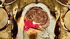 Snímek z magnetické rezonance, na kterém je vidt rakovina prostaty (ervené...