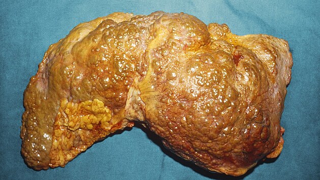 Detail ponien jatern tkn u pacienta s cirhzou.