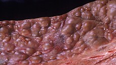 Detail poniené jaterní tkán u pacienta s cirhózou.