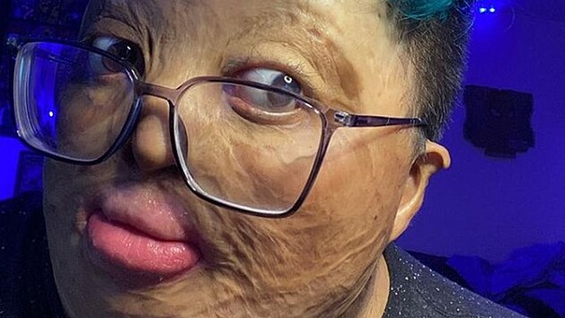 Joshua Reyes ve dvou letech utrpěl popáleniny na pětadevadesáti procentech... Joshua Reyes ve dvou letech utrpěl popáleniny na pětadevadesáti procentech...