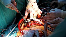 Technika transplantace slinivky se v prbhu 40 let výrazn promnila a posunula kupedu. Nyní vyuívají lékai i virtuální realitu
