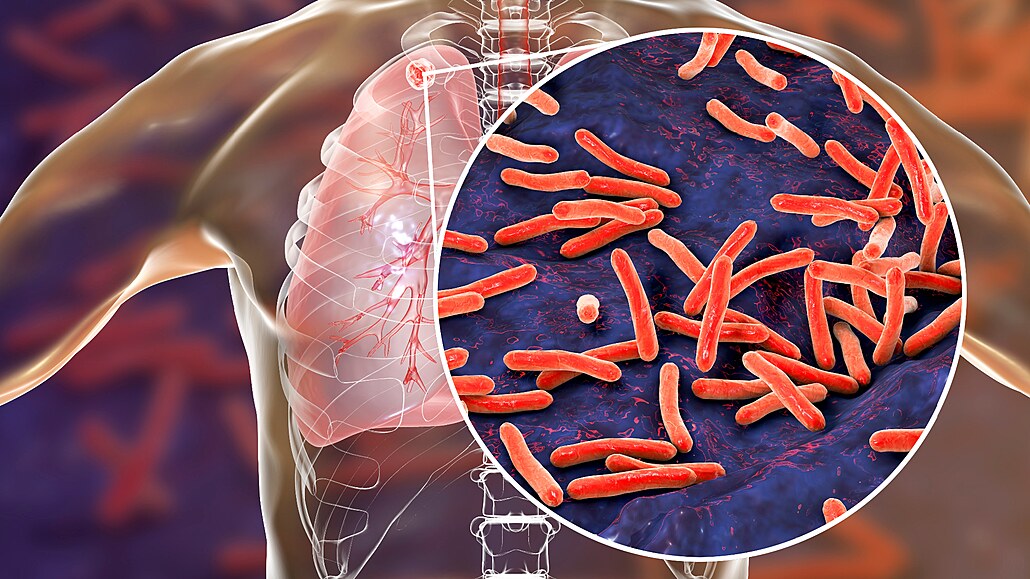 Tuberkulóza je nakalivá infekce, která se íí vzduchem (kdy nakaený kale)....