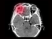 Snímek mozku pacienta s cévní mozkovou mrtvicí