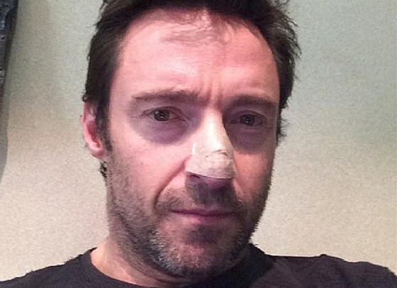 Hugh Jackman ml na nose nádor.