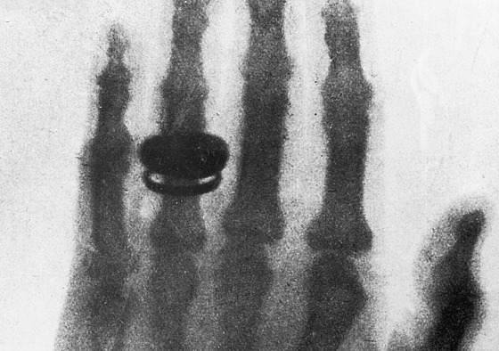 Jedna z prvních rentgenových fotografií. Ruka manelky Conrada Roentgena (23....