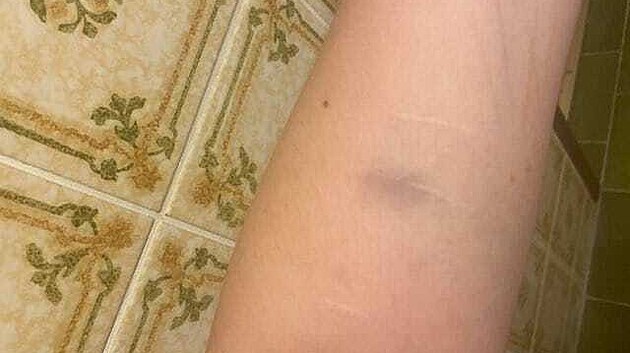 Barbora se den po incidentu s bratislavskými záchranáři vzbudila s modřinami.