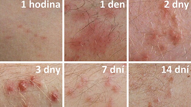 Cerkáriová dermatitida je silně svědivá vyrážka způsobená larvami parazita, které se uvolňují do vody ze sladkovodních plžů. Člověku, který se koupe ve vodě s nakaženými plži, se paraziti rychle zavrtají do kůže. U citlivějších osob, zejména u dětí, nastává alergická reakce. Nejde o závažné onemocnění, protože cerkárie v kůži člověka poměrně záhy hynou, ale příznaky vymizí až po týdnu či dvou.