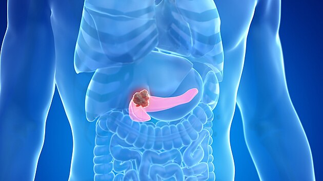 Rakovina slinivky (ilustrační fotografie)