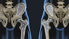 ídké kosti. Zlomenina krku je tém vdy dsledek osteoporózy.