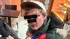 Napadený muž skončil po útoku s tržnými ranami na hlavě. Napadený muž skončil po útoku s tržnými ranami na hlavě.