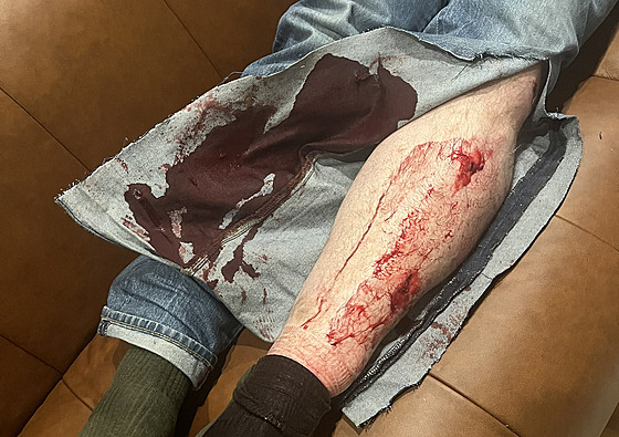 Na snímku jsou vidt zranní, která utrpl Leonid Volkov. (12. bezna 2024)