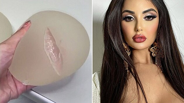 Modelka si musela nechat vyměnit prasklý implantát.