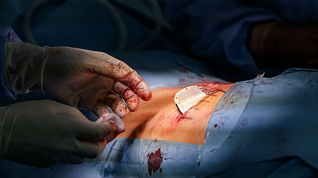 Pohled na nový neurostimulátor, který olomoučtí lékaři voperovali pacientovi jako první v Česku.