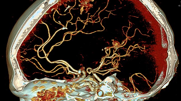 Cévní anomálie v mozku získané z CT přístroje.