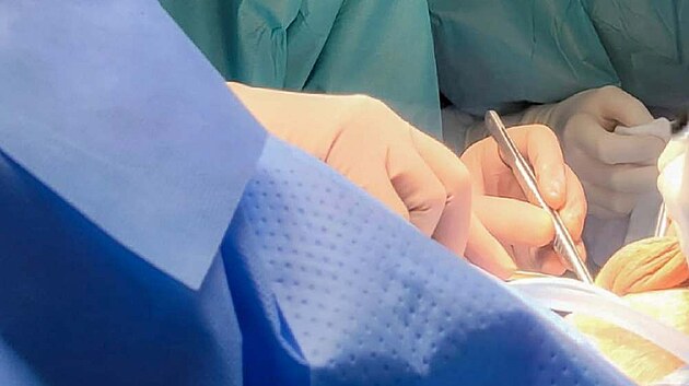 Urologové z FN Olomouc začali jako první z velkých fakultních nemocnic v ČR implantovat nový umělý svěrač Zephyr 375 pro muže s těžkou inkontinencí po operaci prostaty. Tento moderní systém přináší vyšší účinnost, kratší dobu zákroku a nižší riziko komplikací.