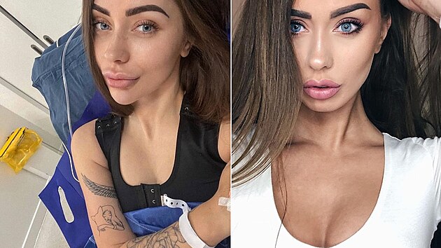 Kráska lituje toho, že si v minulosti augmentaci prsou nechala udělat.