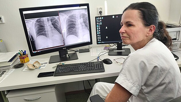 Primářka RDG oddělení Nemocnice AGEL Šternberk MUDr. Jindřiška Judasová vyhodnocuje RTG snímek s Carebotem. (18. listopadu 2025)