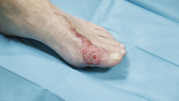 Osmatřicetiletého muže zasáhl elektrický proud, lékaři v Brně mu zachránili popálený palec i ruku. Vyhnul se tak amputaci. (19. listopadu 2025)