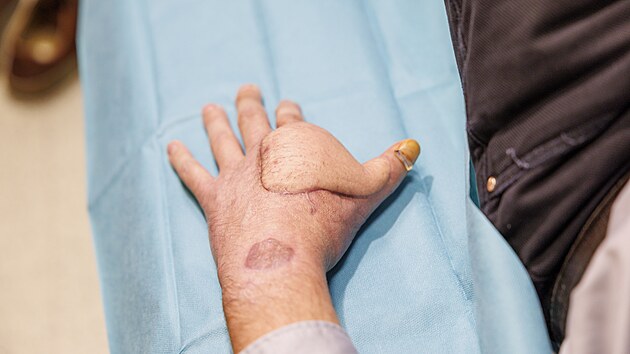 Osmatřicetiletého muže zasáhl elektrický proud, lékaři v Brně mu zachránili popálený palec i ruku. Vyhnul se tak amputaci. (19. listopadu 2025)