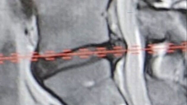 Filip Turek na Instagramu zveřejnil snímek z rentgenu své ploténky.