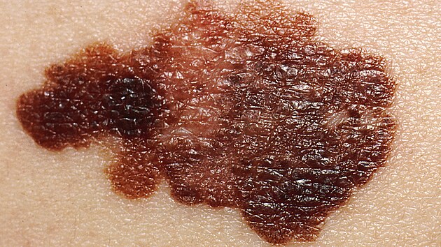 Takto může vypadat melanom. Každá nová nebo měnící se pigmentová skvrna si zaslouží pozornost. Nepodceňujte prevenci ani pravidelné kontroly kůže.