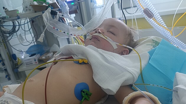 Dvoulet&yacute; Kristi&aacute;nek z Prostějova byl vesel&yacute; a zdrav&yacute; chlapeček. V&scaron;e se změnilo pot&eacute;, co vdechl kousek hru&scaron;ky. Nyn&iacute; je v nemocnici ve vigiln&iacute;m k&oacute;matu.