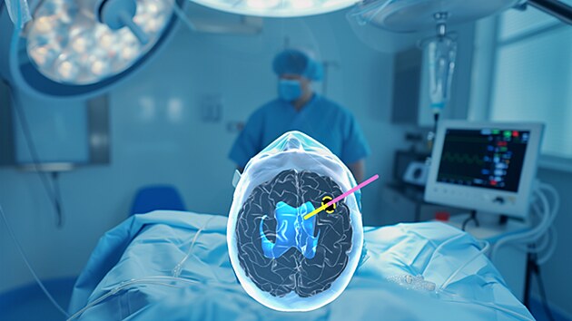 Lékaři neurochirurgického oddělení budějovické nemocnice zavedli v červnu do praxe unikátní technologii. Jako první v ČR a jako třetí tým na světě provedli operaci mozku s využitím 3D brýlí, rozšířené reality a umělé inteligence. (21. července 2026)