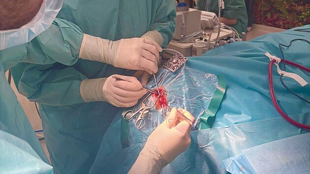 Lékaři neurochirurgického oddělení budějovické nemocnice zavedli v červnu do praxe unikátní technologii. Jako první v ČR a jako třetí tým na světě provedli operaci mozku s využitím 3D brýlí, rozšířené reality a umělé inteligence. (21. července 2026)