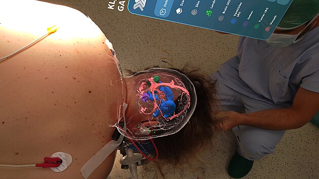 Lékaři neurochirurgického oddělení budějovické nemocnice zavedli v červnu do praxe unikátní technologii. Jako první v ČR a jako třetí tým na světě provedli operaci mozku s využitím 3D brýlí, rozšířené reality a umělé inteligence. (21. července 2026)
