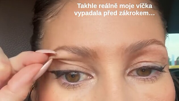 Tereza Kerndlová ukázala fotografie před operací víček.